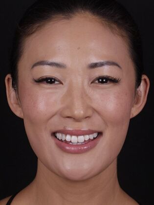 Smile Transformations: Case 5 - Before