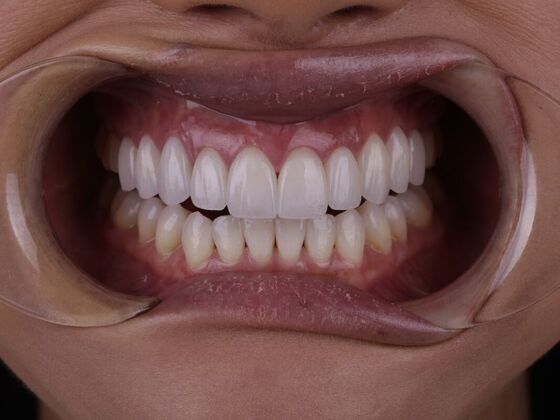 Smile Transformations Case 5 - After