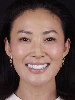 Smile Transformations: Case 5 - After