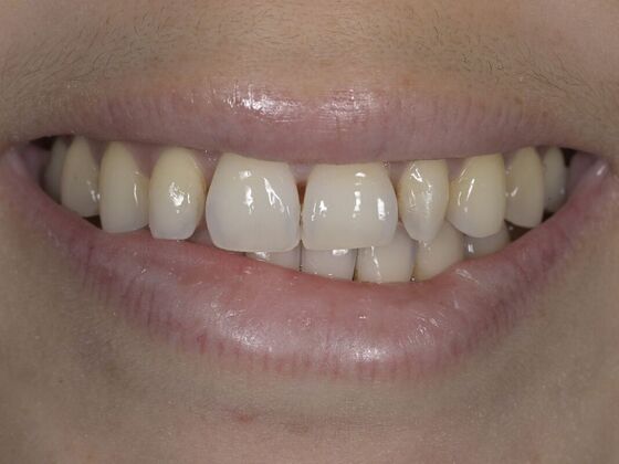 Smile Transformations Case 6 - Before