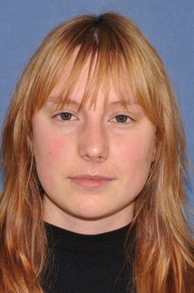 Rhinoplasty Bump with a crooked nasal base - Before