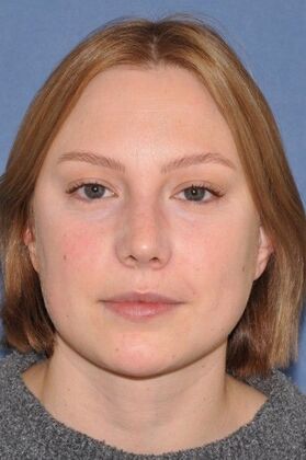 Rhinoplasty Bump with a crooked nasal base - After