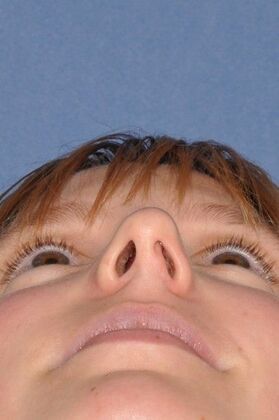 Rhinoplasty: Bump with a crooked nasal base - Before