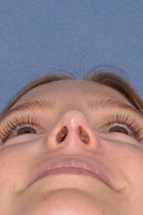 Rhinoplasty: Bump with a crooked nasal base - After