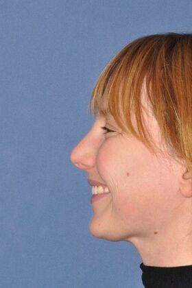 Rhinoplasty: Bump with a crooked nasal base - Before