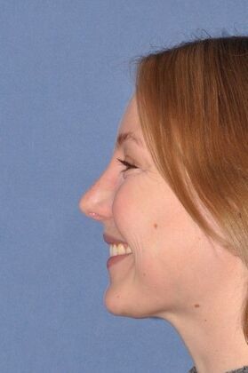 Rhinoplasty: Bump with a crooked nasal base - After