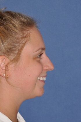 Rhinoplasty: Wide bump and crooked nose - Before