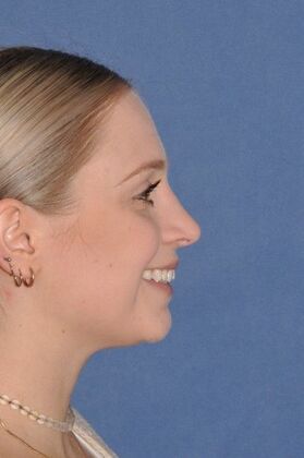 Rhinoplasty: Wide bump and crooked nose - After