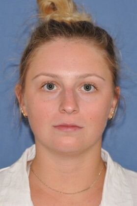 Rhinoplasty Wide bump and crooked nose - Before