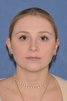 Rhinoplasty Wide bump and crooked nose - After