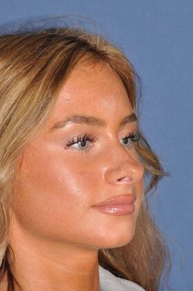 Rhinoplasty Beautiful tip refinement - Before