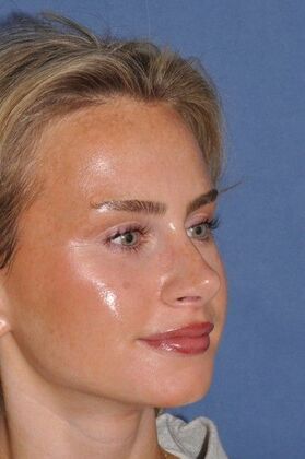Rhinoplasty Beautiful tip refinement - After