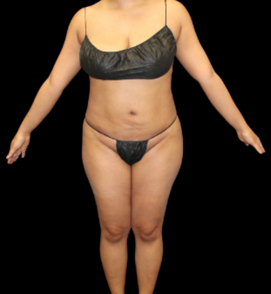 Brazilian Butt Lift: Case 27 - After