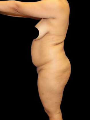 Brazilian Butt Lift Case 27 - Before