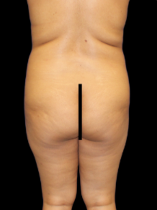 Brazilian Butt Lift BBL 19 - Before