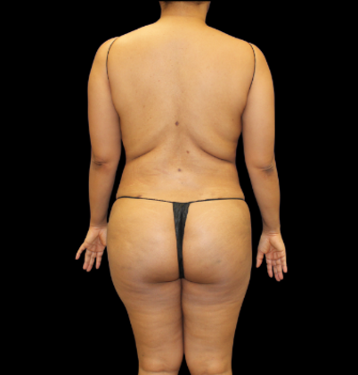 Brazilian Butt Lift: Case 27 - After