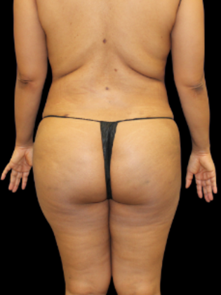 Brazilian Butt Lift BBL 19 - After