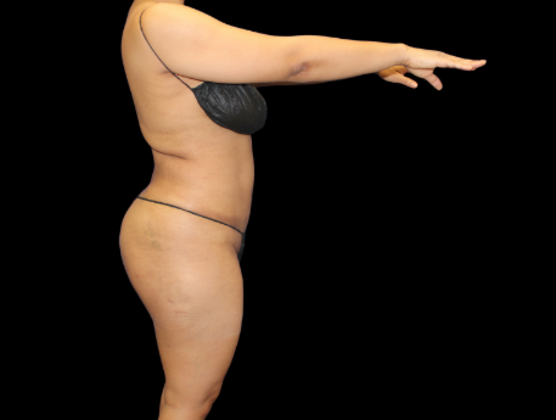 Brazilian Butt Lift: Case 27 - After