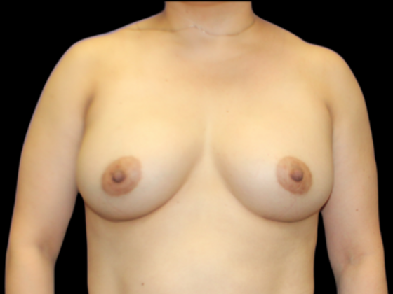 Breast Augmentation Case 5 - After