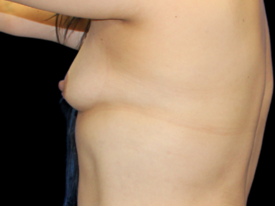 Breast Augmentation: Case 5 - Before