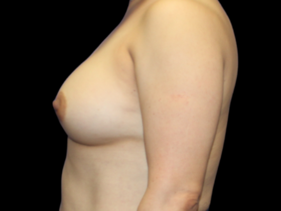 Breast Augmentation: Case 5 - After