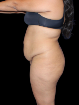 Brazilian Butt Lift: BBL 7 - After