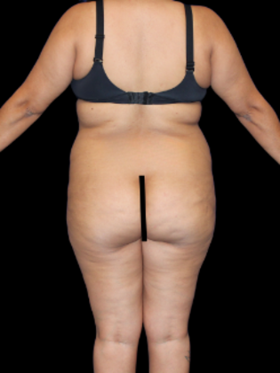 Brazilian Butt Lift Case 28 - Before