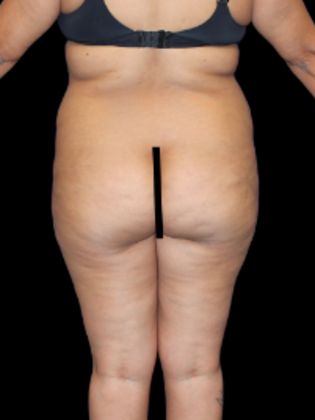 Brazilian Butt Lift BBL 7 - Before