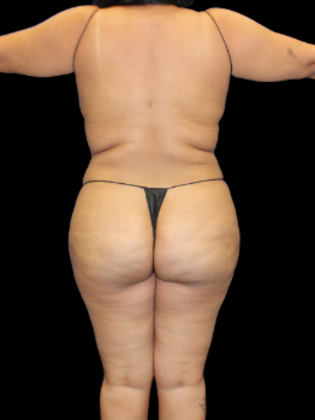 Brazilian Butt Lift Case 28 - After