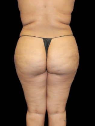Brazilian Butt Lift BBL 7 - After