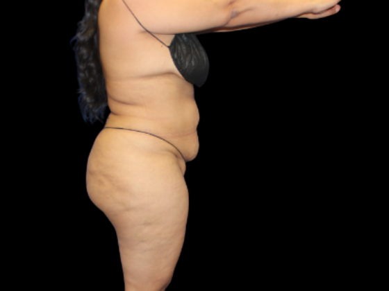 Brazilian Butt Lift: BBL 7 - After