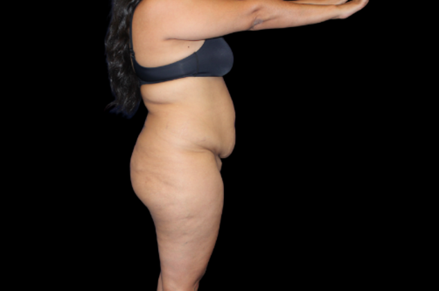 Brazilian Butt Lift: Case 28 - Before