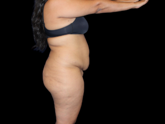 Brazilian Butt Lift: BBL 7 - Before