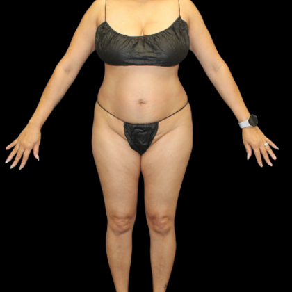 Brazilian Butt Lift: Case 29 - Before