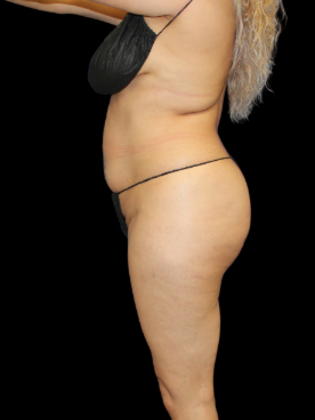 Brazilian Butt Lift: BBL 4 - Before