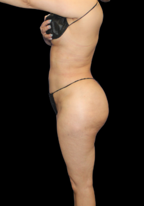 Brazilian Butt Lift: Case 29 - After