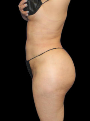 Brazilian Butt Lift: BBL 4 - After
