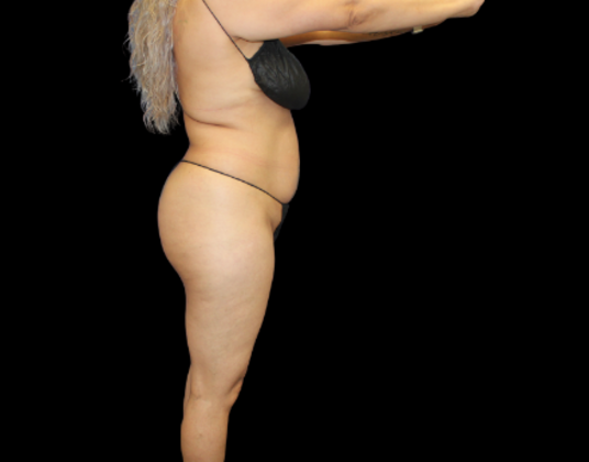 Brazilian Butt Lift: Case 29 - Before