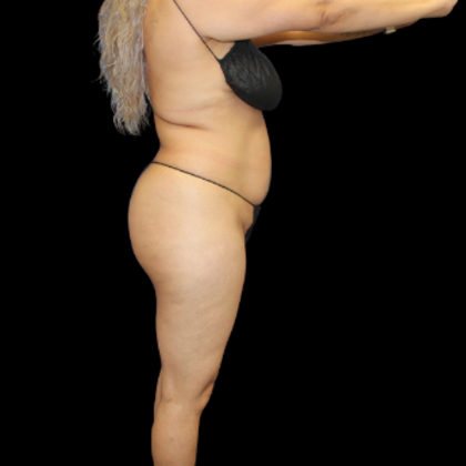 Brazilian Butt Lift: Case 5 - Before