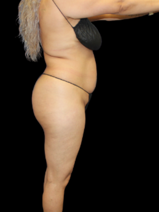 Brazilian Butt Lift: BBL 4 - Before