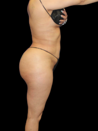 Brazilian Butt Lift: BBL 4 - After