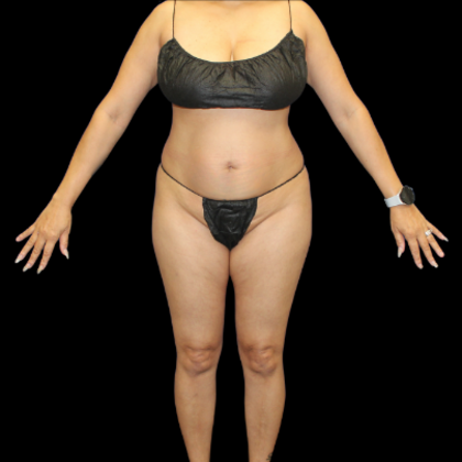 Liposuction Case 18 - Before