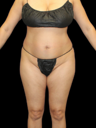 Liposuction Liposuction 7 - Before