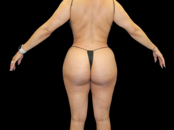 Liposuction: Case 18 - After