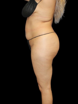 Liposuction: Liposuction 7 - Before