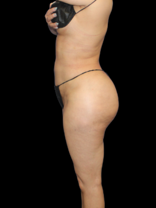 Liposuction: Liposuction 7 - After