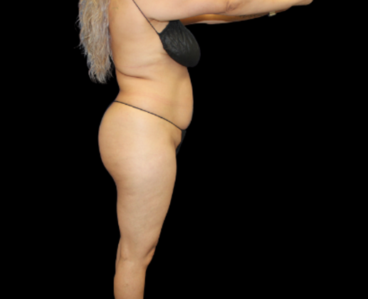 Liposuction: Case 18 - Before