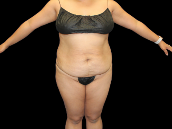 Tummy Tuck Case 11 - Before
