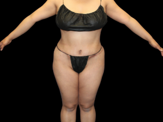 Tummy Tuck Case 11 - After