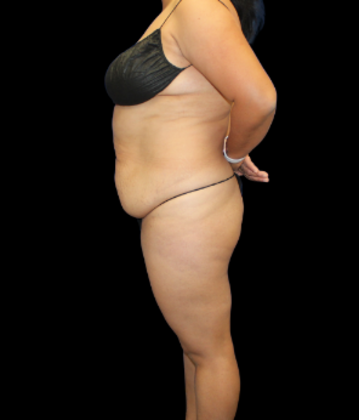 Tummy Tuck: Case 11 - Before